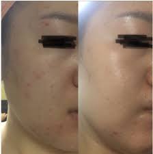 ricopin ビフォーアフター集が凄い 確実に肌を変える再生化粧品効果 イルティン 肌再生mtsプログラム ダーマローラー 化粧品 おすすめ 化粧品