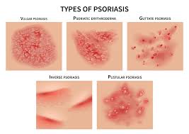 Image result for psoriasis
