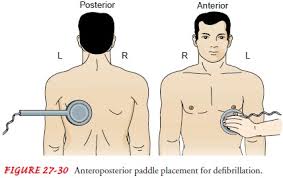 With the paddles still in their holders on the defibrillator, grasp the paddle handles and press the apex. Cardioversion And Defibrillation Adjunctive Modalities And Management