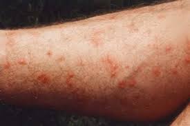 Image result for mite bites on humans