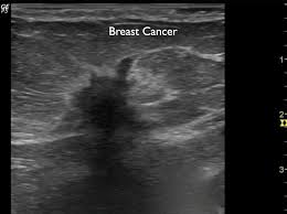 Breast ultrasound is not usually done to screen for breast cancer. Beneath The Surface A Guide To Breast Imaging Breast360 Org The American Society Of Breast Surgeons Foundation