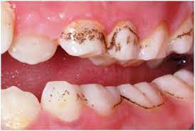 Lifestyle How To Prevent Black Stains On Teeth Black Stains Stained Teeth Teeth Stain Remover