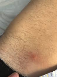 Ingrown hairs are itchy, sometimes painful, and can look similar to pimples. Ingrown Hair Sore On Leg
