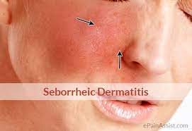 Seborrheic Dermatitis Or Seborrheic Eczema Causes Signs Symptoms Treatment Remedies