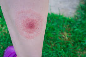 Impetigo, sau bube dulci, este o boala infectioasa de piele, extrem de contagioasa, ce afecteaza cu precadere copiii de obicei, boala afecteaza fata, mainile si picioarele. Infestarile Cauzate De Insecte Si Acarieni Simptome Diagnostic Si Tratament