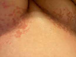 Image result for heat rash under breasts