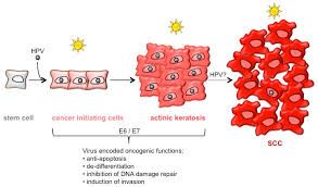 Résultat de recherche d'images pour "human papillomavirus"