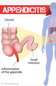This article is going to focus and let you know about the best fruits for diabetes that you can munch on without there are a few restrictions to the notion but fruits are not something a diabetic patient completely needs to uproot from their diet. Appendicitis Causes Symptoms Diagnosis Treatment Complications And Prevention