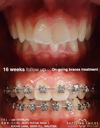 Find here online price details of companies selling dental braces. Dazzling Smiles Dental Dental Clinic In Kuala Lumpur Malaysia