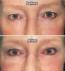 Upper blepharoplasty recovery at 6 weeks
