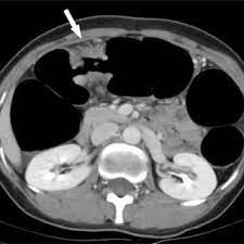 Does/or did your colon, rectal tumour show in the ct scan, and did the radiologist report on it. A 39 Year Old Woman With Mid Transverse Colon Cancer Axial Ct Scan Download Scientific Diagram