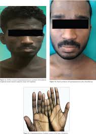 Image result for Diffuse Hyperpigmentation