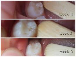 If you already have a cavity, and are seeking treatment, please give our dental office a call today, or contact us here. More Photographic Proof Cavities Heal Healthy Home Economist