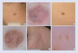 Carcinomas may spread to other parts of the body, or be confined to the primary location. Uncommon Subtypes Of Basal Cell Carcinoma A Clinical View Of Download Scientific Diagram