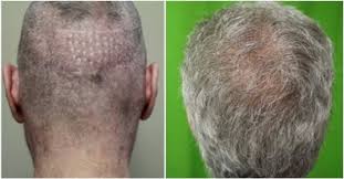 Beard hair transplant to head. Beard Hair To Head Transplant Dermhair Clinic L A 1 310 318 1500