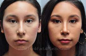 How much does a nose job cost in texas. Rhinoplasty Houston Nose Job Surgeon Houston Tx Funk Facial Plastic Surgery