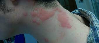 Mosquito Bed Bug Bites What S The Difference Rentokil