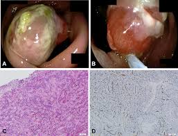 Image result for Pyogenic Granuloma