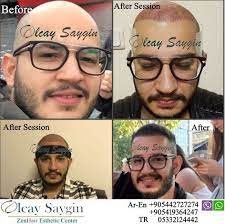 Photo Of Zain Hair Esthetic Center Hair Transplant Hair Transplant Results Hair Transplan Hair Transplant Results Hair Transplant Uk Hair Transplant Women
