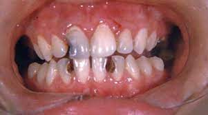You might notice it as a dark spot on the tooth. Tooth Decay Or Cavities Nikhil M Patel Dmd Laser Dentistry