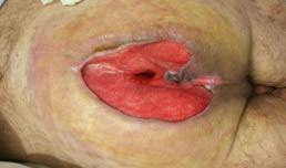Fournier's gangrene, ludwig's angina, clostridial myonecrosis (gas gangrene) empiric therapy (pathogen unknown) immediate surgical debridement and culture Fournier S Gangrene After Hemorrhoidectomy Case Report And Review Of Literature Medcrave Online