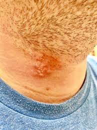 Wouldn't stop me from befriending you. What S Causing This Man S Folliculitis Barbae Consultant360