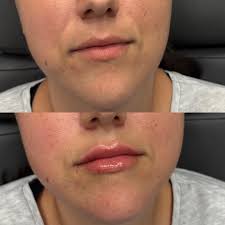 Erin Clouser RN,BSN (@erin_clouser_injects) • Instagram photos and videos