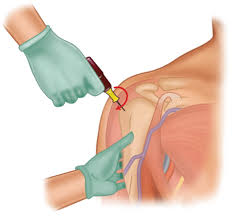 Image result for Intraosseous Access