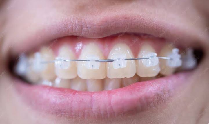 Ceramic Braces product image