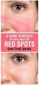 To remove red spots from the skin, you will need 1 tablespoon of lemon juice, 2 teaspoons of honey and 2 tbsp of raw milk. How To Get Rid Of Red Spots On Face 6 Home Remedies And Tips Red Spots On Face Spots On Face Redness On Face