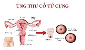 Các lưu ý khi chích ngừa ung thư cổ tử cung 1.1. Váº¯c Xin Ngá»«a Ung ThÆ° Cá»• Tá»­ Cung Ä'Æ°á»£c Phat Triá»ƒn NhÆ° Tháº¿ Nao Vinmec