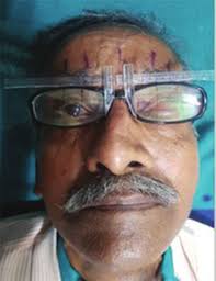 Comparison of Two Novel Techniques for Iris Centering in Ocular Prosthesis