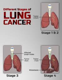 Why is cancer so difficult to treat? Why Is Lung Cancer So Difficult To Treat Surgeon Answers Scary Symptoms