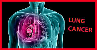See full list on mayoclinic.org Unignorable Early Signs And Symptoms Of Lung Cancer Album On Imgur
