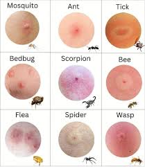 Image result for flea bites