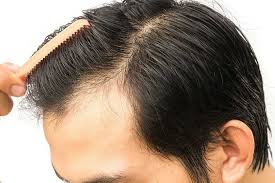 Scientists have completely reversed hair loss in three people by giving them a drug normally used to treat bone marrow disorders. What Makes You A Good Candidate For A Hair Transplant