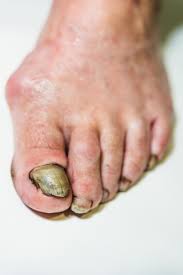 Image result for Onycholysis feet