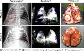 Image result for lung cancer xray