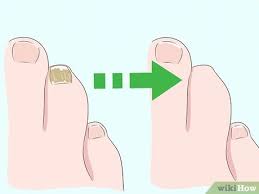 Einen Schwarzen Zehennagel Behandeln Wikihow