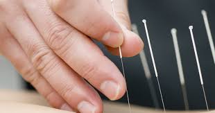 54 pcs ancient acupuncture needles display (침액자) 중국의 require acupuncture license number for buying needles. Acupuncture For Chronic Stiff Neck