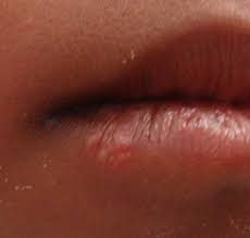 The hsv model….blah blah blah… Herpes Simplex Virus Hsv Varicella Zoster Virus Vzv Infectious Disease Advisor
