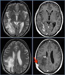 Multiple sclerosis (ms) is a relatively common acquired chronic relapsing demyelinating disease involving the central nervous system, and is the second most common cause of neurological impairment in young adults, after trauma 19. The Radiology Assistant Multiple Sclerosis Diagnosis And Differential Diagnosis