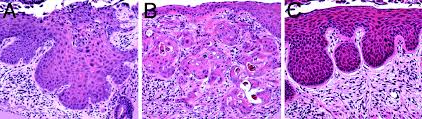 With this form of dysplasia, cells are normal, except for their location. Estrogen Contributes To The Onset Persistence And Malignant Progression Of Cervical Cancer In A Human Papillomavirus Transgenic Mouse Model Pnas