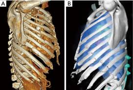 Rhomboid muscle pain may be caused by overuse or injury to the muscle. Three Common Exposures Of The Chest Wall For Rib Fixation Anatomical Considerations Greiffenstein Journal Of Thoracic Disease