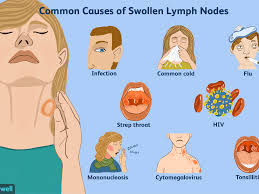 So when i read a forum user posting about their experience with neck pain, it rang all sorts of familiar bells. How To Tell A Lump From A Lymph Node