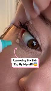 Taking off my own skin tag 😨