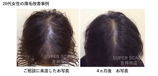 薄毛治療の薬なしで発毛した女性の発毛実績 薄毛 産後 抜け毛 ヘアスタイル ロング