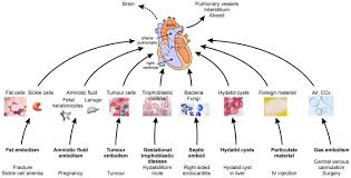 A pulmonary embolism (pe) is the blockage of the pulmonary artery (a major artery in the lung), usually caused by a blood clot. Nonthrombotic Pulmonary Embolism Air Amniotic Fluid Fat Tumor Pulmonology Advisor
