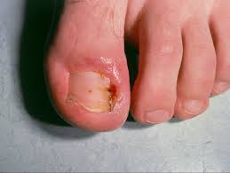 Image result for Paronychia feet