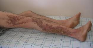 Darier S Disease Wikipedia